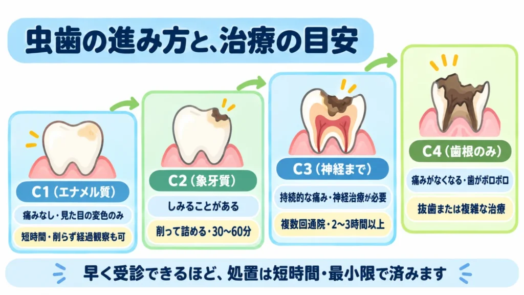 虫歯がC1からC4へ進むにつれて、痛みの有無と治療時間の目安が変わることを示した図解